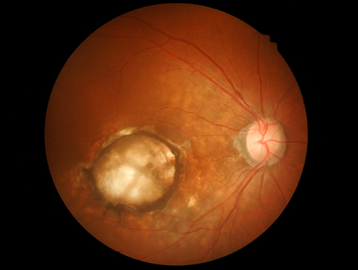 age-related macular degeneration